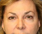 Eyelid Refresh San Diego 79 - before