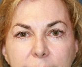 Eyelid Refresh San Diego 79 - after