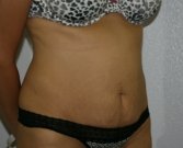 Tummy Tuck San Diego 62 - before