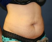 Tummy Tuck San Diego 63 - before