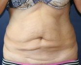 Tummy Tuck San Diego 65 - before