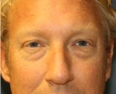 Eyelid-rejuvenation-80 - before