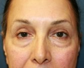 Eyelid-rejuvenation-81 - before
