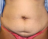 Tummy Tuck Case 20 - before