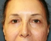 Eyelid-rejuvenation-81 - after