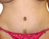 Tummy Tuck Case 20 - after