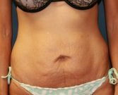 Tummy Tuck San Diego 70 - before