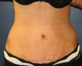 Tummy Tuck San Diego 70 - after