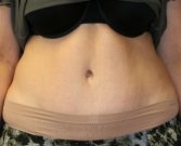 Tummy Tuck San Diego 71 - after