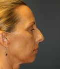 Rhinoplasty (nose re-shaping) 48 - before