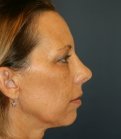 Rhinoplasty (nose re-shaping) 48 - after