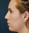 Rhinoplasty (nose re-shaping) 49 - before