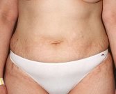 Tummy Tuck Case 21 - before