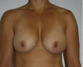 Revision Breast Augmentation & Breast Lift - before