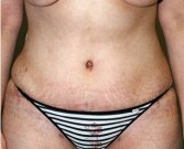 Tummy Tuck Case 21 - after