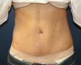 Tummy Tuck San Diego 72 - after