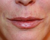 Juvederm in Lips, One Milliliter - after