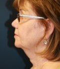 Neck and Lower Face Lift - before