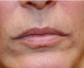 Lips filled with 1 ml Juvederm - before