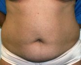 Tummy Tuck Case 22 - before