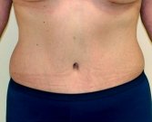 Tummy Tuck Case 22 - after
