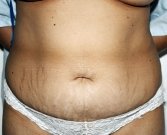 Tummy Tuck Case 23 - before