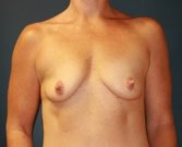 Breast Augmentation 108 \"gummy bear\" - before