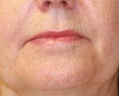 Lip Corners & Laser Rx - before