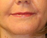 Lip Corners & Laser Rx - after