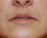 Corner Lip Lift (Sad to Pleasant) - before