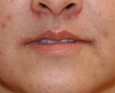 Corner Lip Lift (Sad to Pleasant) - after
