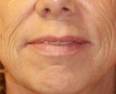 Laser of Lips and Corner Lift - before