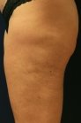 Thigh Cellulite Thermi-RF treatment - before