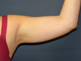 Arm Liposuction plus Skin Tightening - before