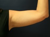 Arm Liposuction plus Skin Tightening - after