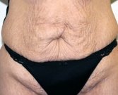 Tummy Tuck Case 24 - before
