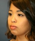 Rhinoplasty San Diego 47 - before