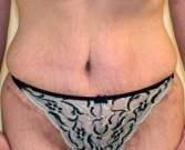 Tummy Tuck Case 24 - after