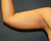 Liposuction Arms (right) - before