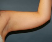 Liposuction Left Arm - before