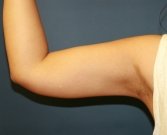 Liposuction Right Arm - after