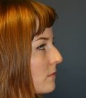 Remove Bump on Nose San Diego - before
