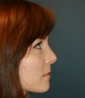 Remove Bump on Nose San Diego - after