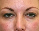 Blepharoplasty Case 11 - before