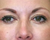 Blepharoplasty Case 11 - after