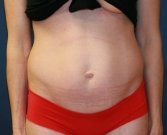 tummy-tuck-san-diego-73 - before