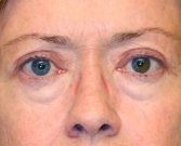 Blepharoplasty Case 12 - before