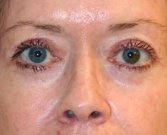 Blepharoplasty Case 12 - after