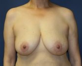 Breast Lift 28 - before