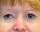 Blepharoplasty Case 13 - before